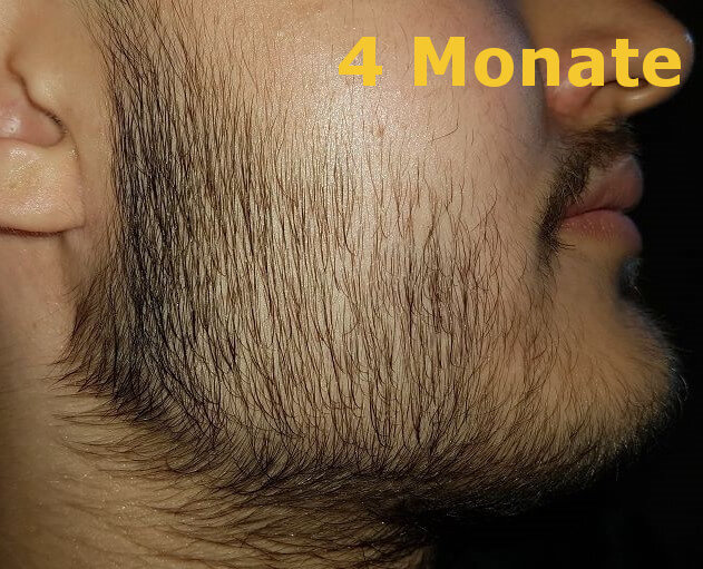 Bartwuchs minoxidil Bartwuchs anregen
