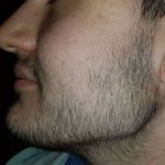 Erfahrungen bart minoxidil Bartwuchsmittel